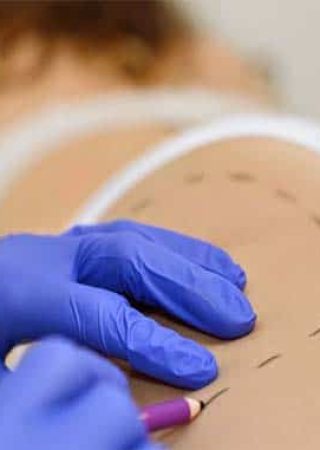 Lipodissolve o intralipoterapia